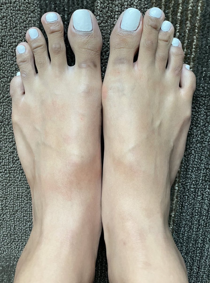 SymmetryFeet's tweet photo. Long, white pedicured size 10 Indian tops in perfect symmetry โ courtesy of @loveathena101! ๐ฎ๐ณ Follow her for any customs or inquiries! ๐ฅ๐ฃ #SymmetryFeet #PrettyToes #PrettyFeet #AsianToes #FootFetish #WhiteTies #LongToes #IndianFeet https://t.co/rIiDfXLNny