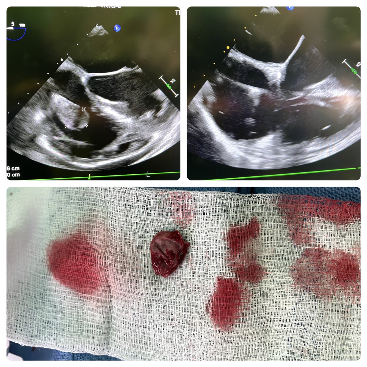 Divyang Patel (@divyangrpatel) on Twitter photo Vegetation removal with <a href="/InariMedical/">Inari Medical</a> flowtriever and then extraction of riata in a patient with bacteremia and icd. Easy to learn and use <a href="/MisraSatish/">Satish Misra</a> <a href="/rohitdukemehta/">Rohit Mehta</a> <a href="/JonPicciniSr/">Jonathan Piccini, MD, MHS</a> <a href="/ErichKiehl/">Erich Kiehl MD</a> <a href="/tdc0112358/">T Callahan</a>. Need data on how to effectively manage large vegetations on leads. Vegetation removal with <a href="/InariMedical/">Inari Medical</a> flowtriever and then extraction of riata in a patient with bacteremia and icd. Easy to learn and use <a href="/MisraSatish/">Satish Misra</a> <a href="/rohitdukemehta/">Rohit Mehta</a> <a href="/JonPicciniSr/">Jonathan Piccini, MD, MHS</a> <a href="/ErichKiehl/">Erich Kiehl MD</a> <a href="/tdc0112358/">T Callahan</a>. Need data on how to effectively manage large vegetations on leads.
