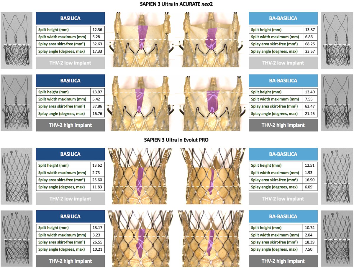Dr. Gilbert Tang (@gilberttangmd) on Twitter photo Just out <a href="/JACCJournals/">JACC Journals</a> #JACCINT BA-BASILICA vs BASILICA: more spray and opening with S3 in Acurate than S3 in Evolut TAV-in-TAV. Implications?
jacc.org/doi/full/10.10… <a href="/J_Sathananthan/">Janar Sathananthan</a> <a href="/CurioJonathan/">Jonathan Curio</a> <a href="/AdamGreenbaumMD/">Adam Greenbaum</a> <a href="/CathElectroSurg/">Jaffar Khan</a> <a href="/DeeDeeWangMD/">Dee Dee Wang MD</a> <a href="/G_Tarantini01/">Giuseppe_Tarantini</a> <a href="/bapat_savrtavr/">vinayak bapat</a> Just out <a href="/JACCJournals/">JACC Journals</a> #JACCINT BA-BASILICA vs BASILICA: more spray and opening with S3 in Acurate than S3 in Evolut TAV-in-TAV. Implications?
jacc.org/doi/full/10.10… <a href="/J_Sathananthan/">Janar Sathananthan</a> <a href="/CurioJonathan/">Jonathan Curio</a> <a href="/AdamGreenbaumMD/">Adam Greenbaum</a> <a href="/CathElectroSurg/">Jaffar Khan</a> <a href="/DeeDeeWangMD/">Dee Dee Wang MD</a> <a href="/G_Tarantini01/">Giuseppe_Tarantini</a> <a href="/bapat_savrtavr/">vinayak bapat</a>