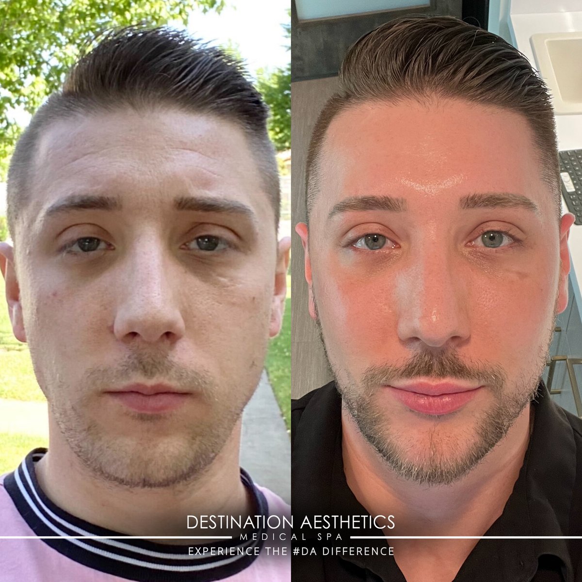DestAesthetics's tweet photo. GLOW UP 🤩

What good skincare + a combination of different treatments can do for you >

Since 2019, this beautiful human has done the following: 
- Fractional Laser x1 
- Botox® every 3 months for the last year and a half
- Jawline + chin filler
- 1 syringe of filler &amp; 1 PRFM tr https://t.co/SjD98KZt7n