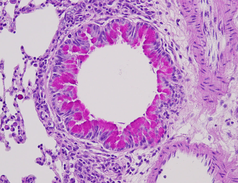 Science Magazine (@sciencemagazine) on Twitter photo Why do some #asthma patients have a poor response to inhaled #corticosteroids?
A new <a href="/ScienceTM/">Science Translational Medicine</a> study in mice and humans now connects #neutrophil activity with corticosteroid resistance. scim.ag/35x Why do some #asthma patients have a poor response to inhaled #corticosteroids?
A new <a href="/ScienceTM/">Science Translational Medicine</a> study in mice and humans now connects #neutrophil activity with corticosteroid resistance. scim.ag/35x