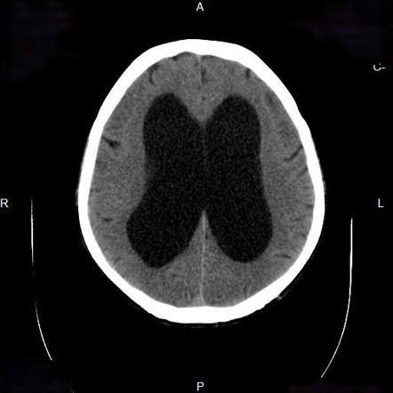 A patient p/w abnormal gait,memory loss which interferes with his daily routine& is socially inactive. He also c/o urinary incontinence. What's your diagnosis?
#MedTwitter #medicine #MedEd #radiology #Clinical #neurotwitter