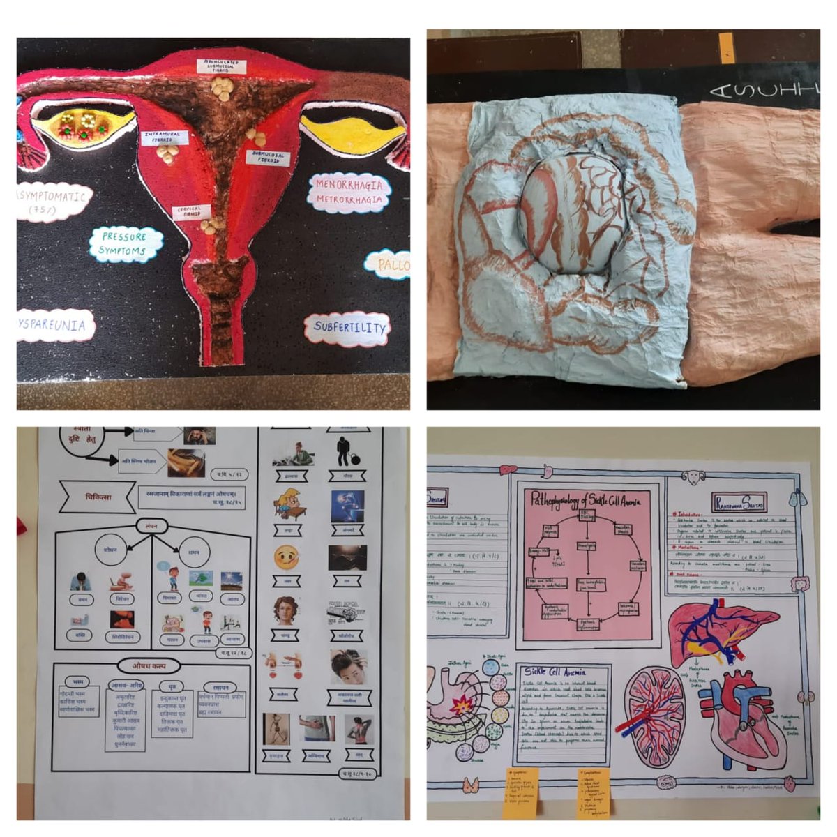 g_ayurveda's tweet photo. On the occasion of sickle cell day, Dept. of Roga Nidana & Vikriti Vigyana organized Poster & Model Competition for the students.
20 students including PG Scholars participated in the programme.
#sicklecellday
#Awareness
#GJPIASR
#CVM
#CVMU https://t.co/6diwOZNCZI