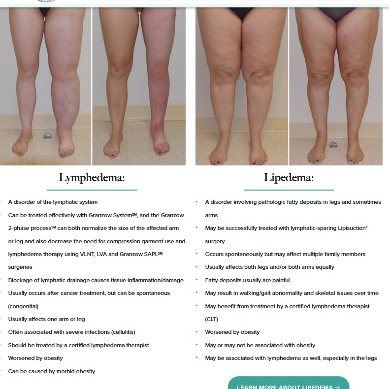 @__morose I have lymphedema and I confused so I googled it yeah the lymphedema 1 it's definitely what i got reading that last part hit hard I've always blamed myself and ig it's true my chronic skin infections and lymphedema was caused by being morbidly obese another reason to hate myself