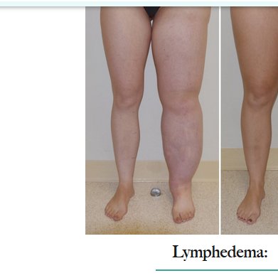 @__morose My left leg is swollen like that only much much worse ironic that I'm complaining about it on the Internet instead of actually doing my lymphedema pumps like I should be