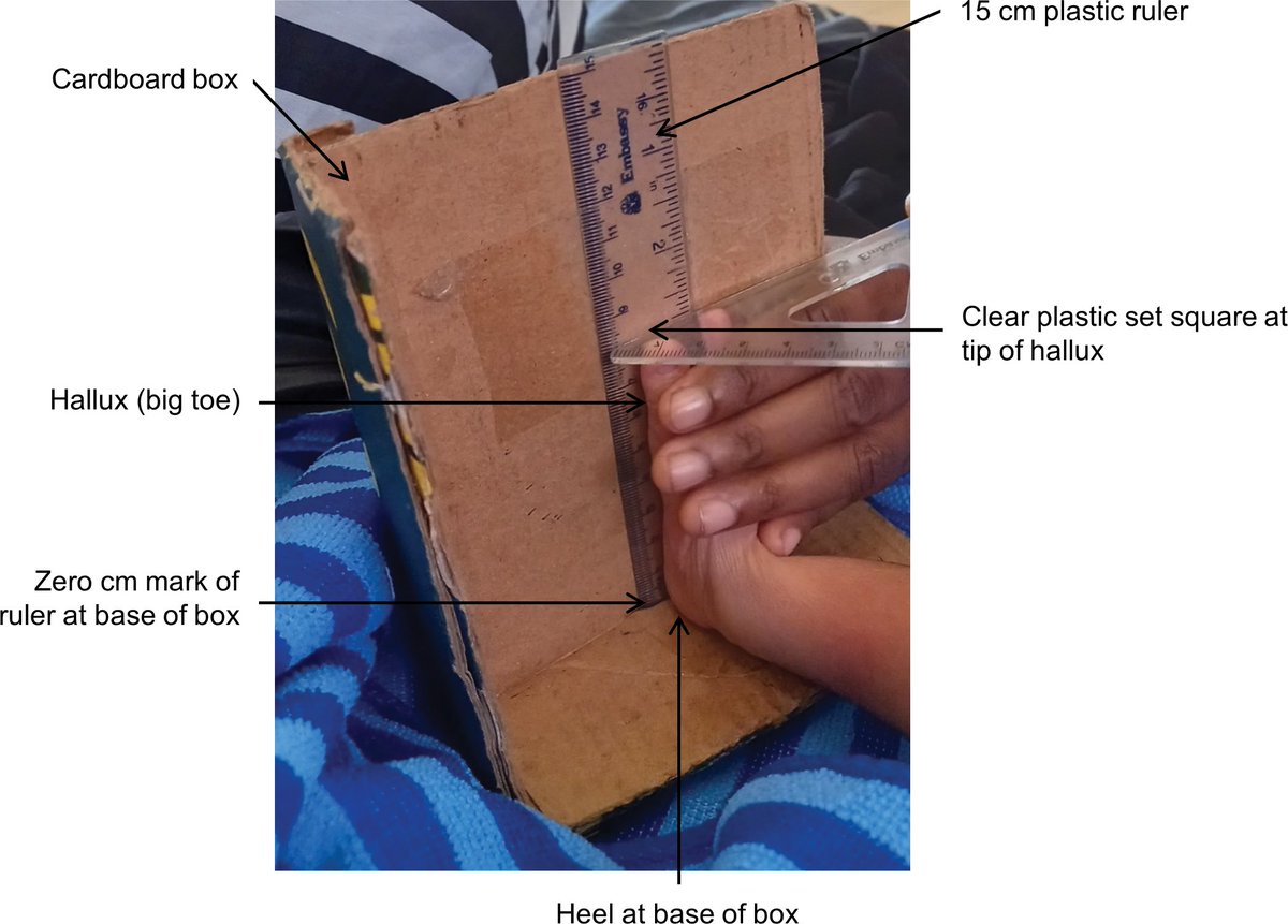 Nicola Low #EveryDayCounts #StillFBPE (@nicolamlow) on Twitter photo Alice Mengi & team found, "When birth at a health facility is not possible, foot length measurement can identify #LowBirthWeight and #PretermBirth in newborns" 👣#Neofoot <a href="/pngimr/">PNG Institute of Medical Research</a> Madang
Low-technology #diagnostics for #EveryNewborn health
🙏<a href="/PLOSGPH/">PLOS Global Public Health</a> journals.plos.org/globalpubliche… Alice Mengi & team found, "When birth at a health facility is not possible, foot length measurement can identify #LowBirthWeight and #PretermBirth in newborns" 👣#Neofoot <a href="/pngimr/">PNG Institute of Medical Research</a> Madang
Low-technology #diagnostics for #EveryNewborn health
🙏<a href="/PLOSGPH/">PLOS Global Public Health</a> journals.plos.org/globalpubliche…