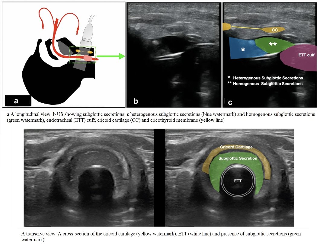 An exciting application of ultrasound to assess the presence of subglottic secretion above the endotracheal tube cuff and the risk of ventilator-associated pneumonia (VAP) #POCUS #MedEd #Foamed 
bit.ly/3JrQ6nz