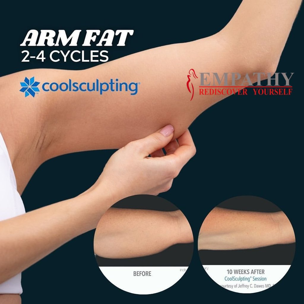 #coolsculptinguniversity #empathycoolsculpting 
#allergancoolsculpting#bodycontouring#Bodysculpting #freezethatfat #abdomen #underarms #innerthighs #outerthighs #hips #doublechin #flanks #upperarms #lovehandles .

Empathy Laser & Coolsculpting Clinic 

PHONE ~ 9811157787.