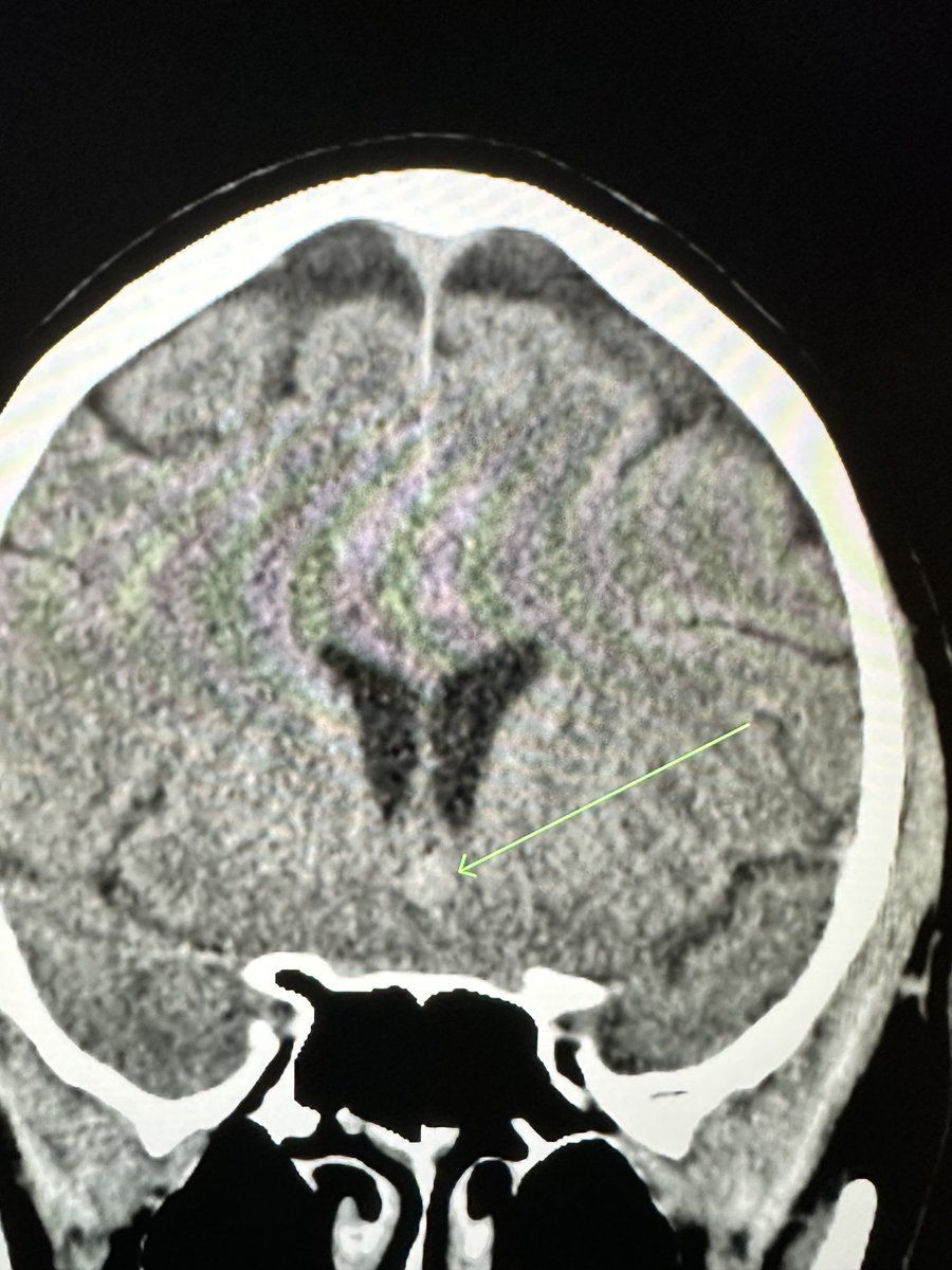 Non-con head. Likely ACOM aneurysm