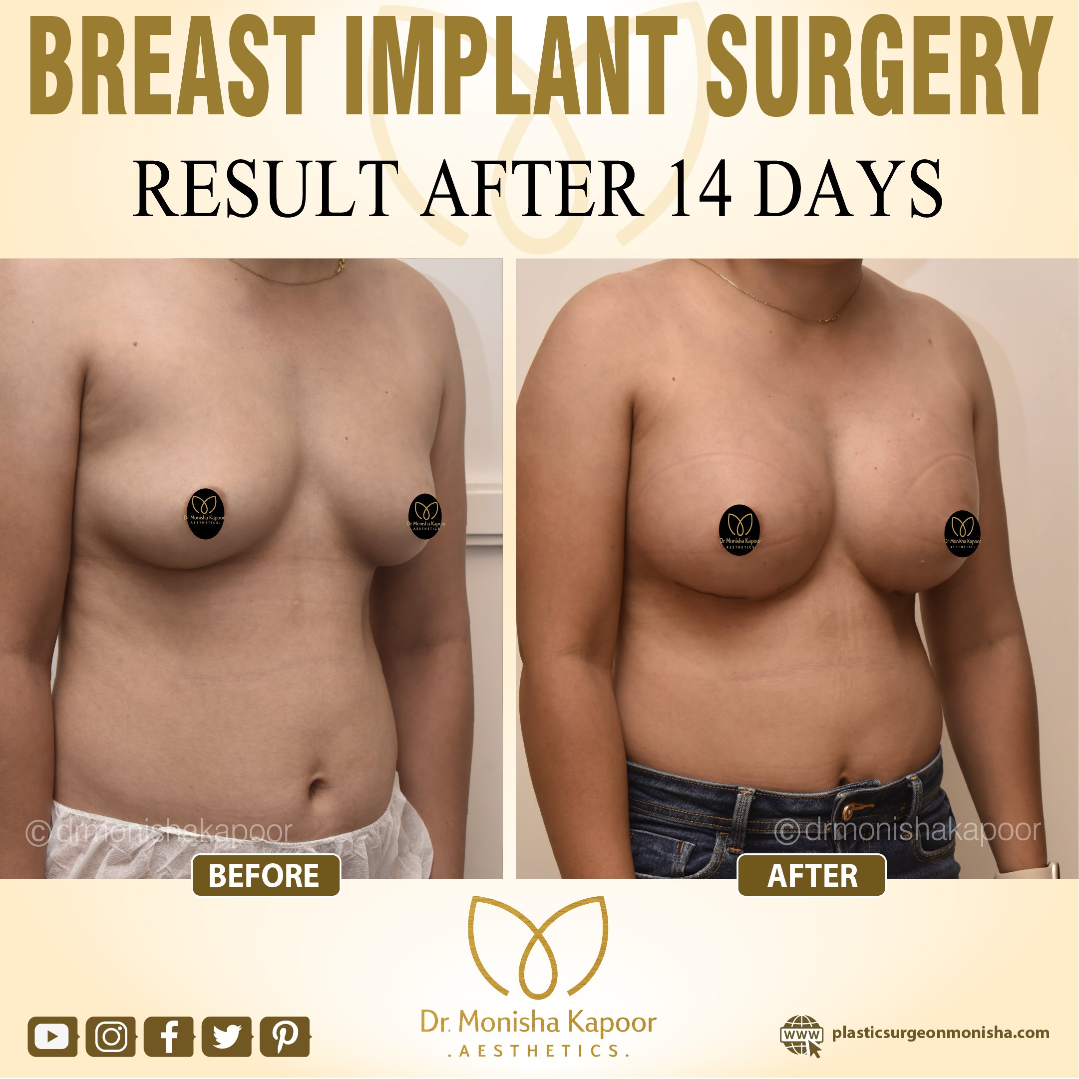 Dr Monisha Kapoor on X: ""Discover the 'No Touch' Technique for Natural-Looking  Breast Enhancements!" https://t.co/IAnNe2QKIV https://t.co/J8t0VaS8Ju" / X