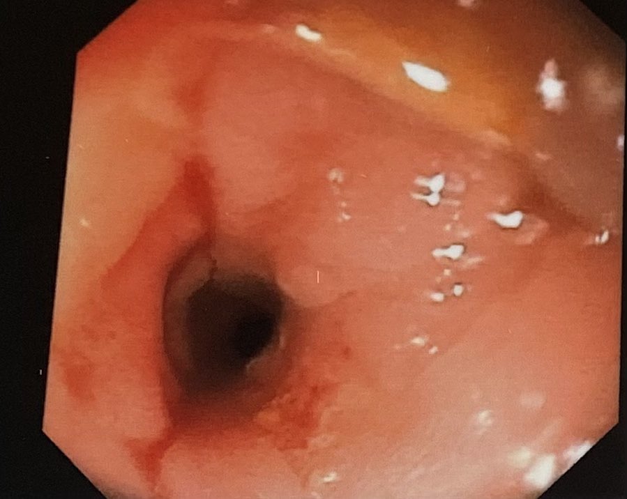 68F. Bilateral Ca breast. Presented with acute intest. Obstr. CT shows multiple narrowings in colon. No LN mass. Colonoscopy outside could not pass beyond stricture in rectum? Ca. We used a pediatric gastroscope to reach cecum. Found 5 smooth narrowings in colon with granulation…