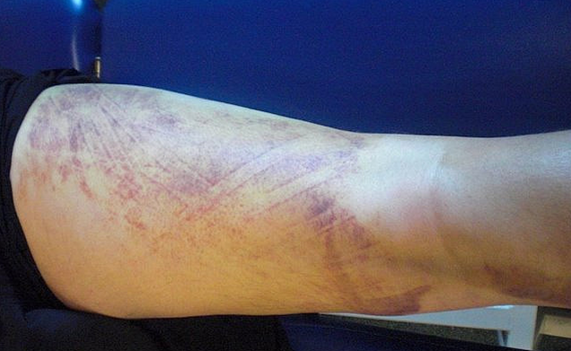 Kinesio_UK's tweet photo. From #lymphoedema to an ankle sprain, if you haven't used #Kinesio Fan cut taping applications they're a great way to assist with swelling. Here's a great example using the tape on a large bruise. https://t.co/OLUDSgk86d