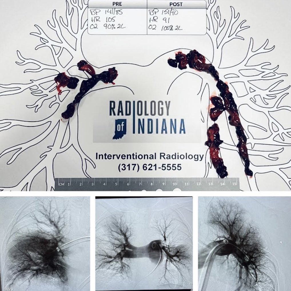 Overnight call case.  Submassive PE. Mechanical thrombectomy yielded all of this clot.  The silly things we would have done to treat this 5 years ago compared to today!!!#clot @WashUIR @SIRspecialists @RadiologyofIN @InariMedical @DrJayMohan