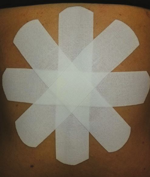Kinesio_UK's tweet photo. A star shape #KinesioTaping application is four I-strips of tape placed over the point of maximum pain, usually applied with some tension on the main strips - but remember to leave the anchors. https://t.co/dL04xLTxR7