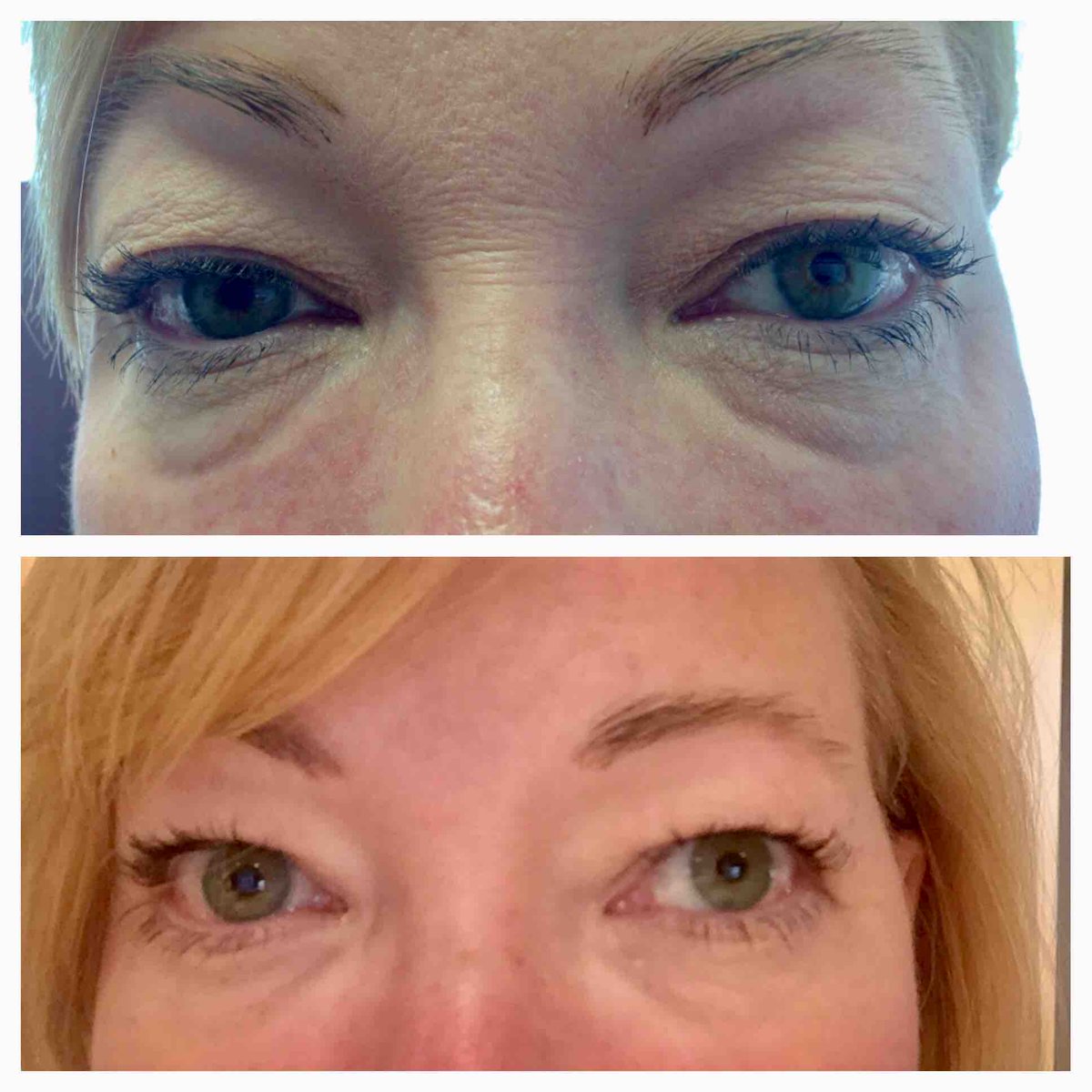 One #syringe of #Restylane in the #teartroughs. Placed with a 25 gauge  #cannula to minimize bruising and swelling. Before pic and 3 days post procedure pic from the patient. #drannetrussell #seibellamedspa #eyes #medspa #antiaging #LittleRock #physician 😍😍❤️ 501-228-6237