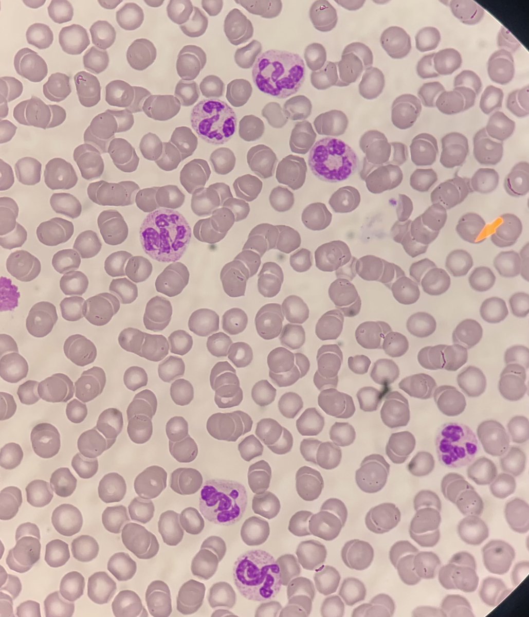Are you aware about effects of glucocorticoids on neutrophils segmentation?hempad#