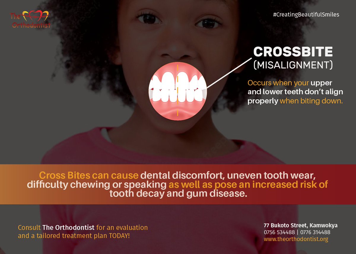 A cross bite occurs when the upper and lower teeth don't align properly when biting down. This causes dental discomfort, uneven tooth wear and poses an increased risk of tooth decay and gum disease

Are you or someone you know affected? Get in touch for a tailored treatment plan!