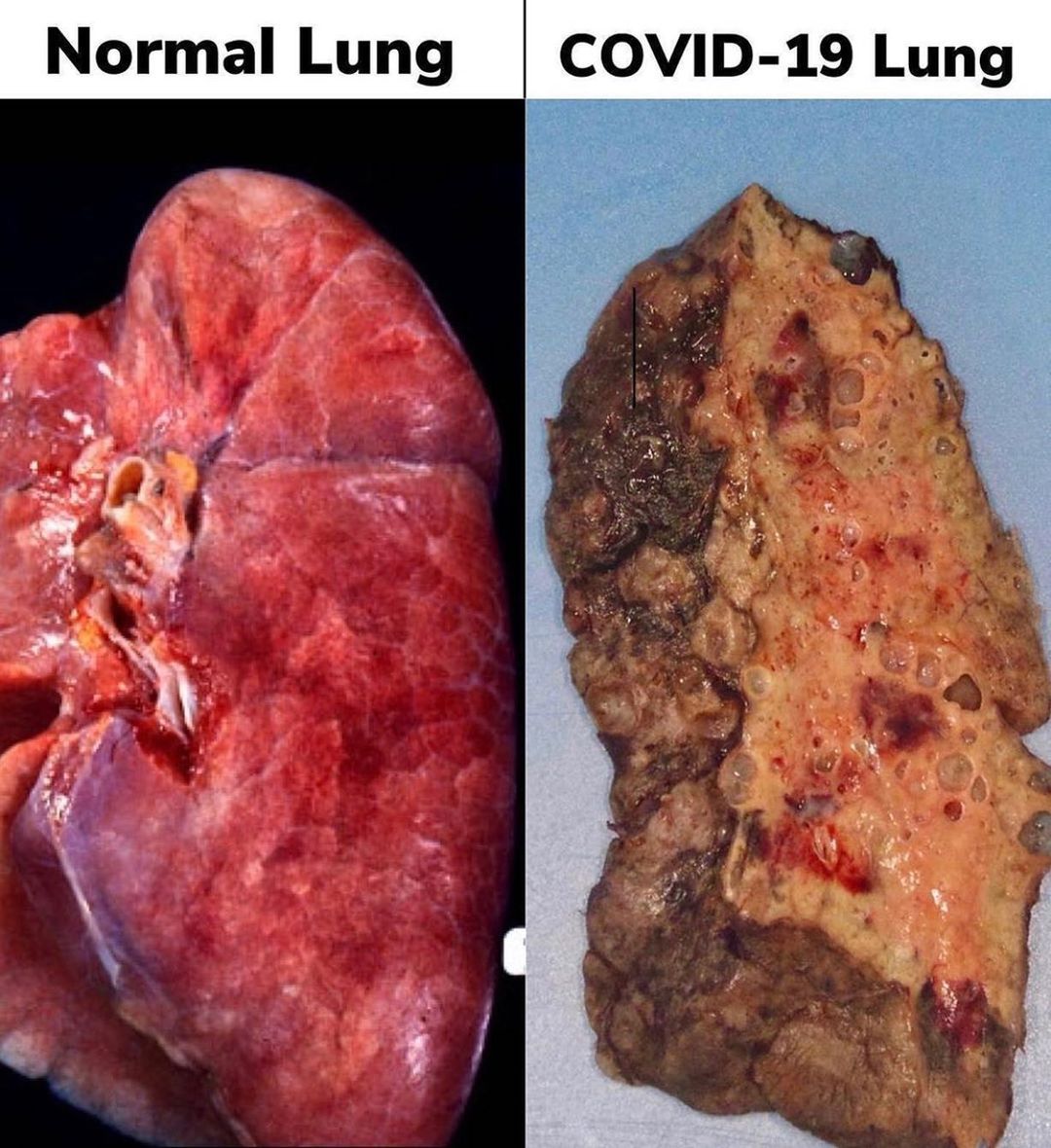 Autopsy of a 20 year old female lungs that has COVID 19