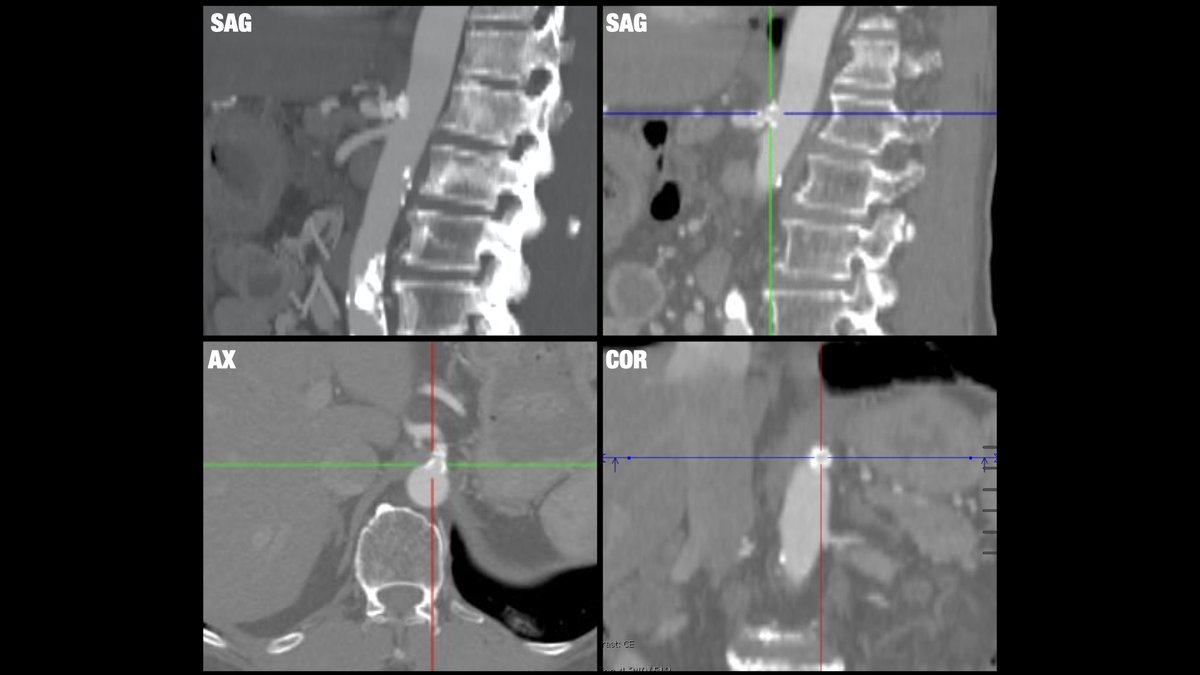 Median arcuate ligament (or celiac artery compression) syndrome, rare condition leading to upper abdominal pain due to vascular compression, treated with endovascular stent here. <a href="/BrighamRad/">Brigham and Women's Radiology</a> @AURtweet <a href="/FOAMrad/">FOAMrad</a> <a href="/SAR_RFS/">SAR Resident and Fellow Section</a> <a href="/futureradres/">Future Radiology Residents</a> <a href="/HarvardMacy/">Harvard Macy</a> <a href="/CBRadiologia/">CBR</a> #MedEd