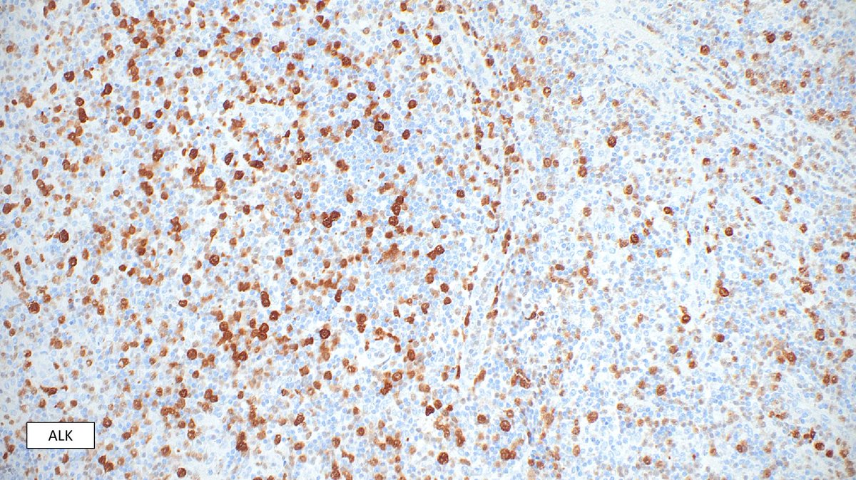 ALK-positive ALCL-"small cell variant":
➡️Very deceptive morphology (NOT anaplastic-looking) can be easily missed 
➡️Leukemic presentation is common
#hemepath #lymsm #PathTwitter #MedTwitter