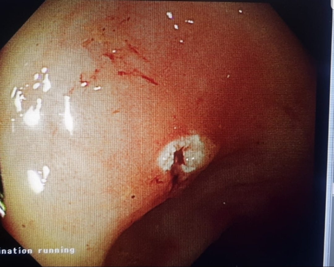 Taalamri's tweet image. 🔴Teaching point; in polypectomy, you need to keep in your mind having a negative margin if the polyp turns out to be malignant.👇🏼 Semi-pendiculated polyp 2cm; positive pathology for malignancy with 4mm clear margin...
@DrSaeeeed
#Teaching 
#polypectomy 
#Basics 
#Colon cancer