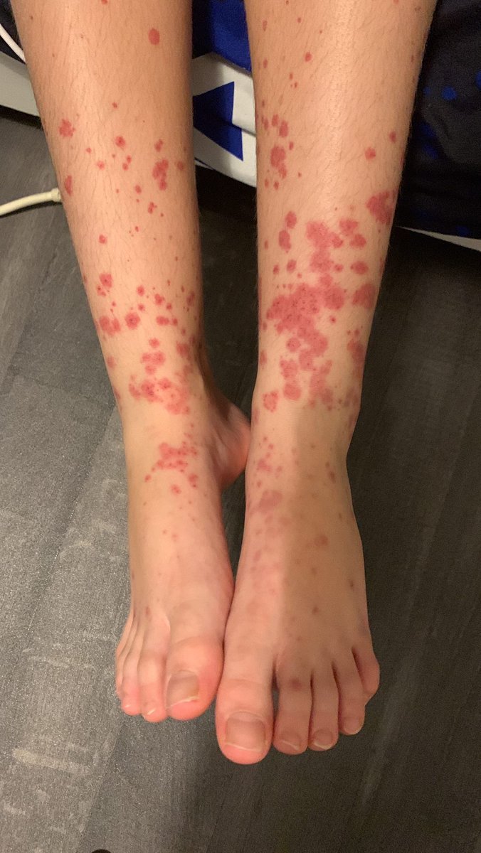 #Lindsay avait appelé à l’aide mais pas entendu….aujourd’hui elle est morte!
L’état du petit #Fares se détériore gravement, et tt la monde ignore cet enfant. 
Aucune leçon n’a été retenue à priori, #nosenfantssontendetresse #HarcelementScolaire @JusticeFar24454