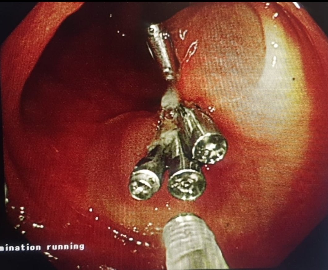 Taalamri's tweet image. 🔴Teaching point; in polypectomy, you need to keep in your mind having a negative margin if the polyp turns out to be malignant.👇🏼 Semi-pendiculated polyp 2cm; positive pathology for malignancy with 4mm clear margin...
@DrSaeeeed
#Teaching 
#polypectomy 
#Basics 
#Colon cancer