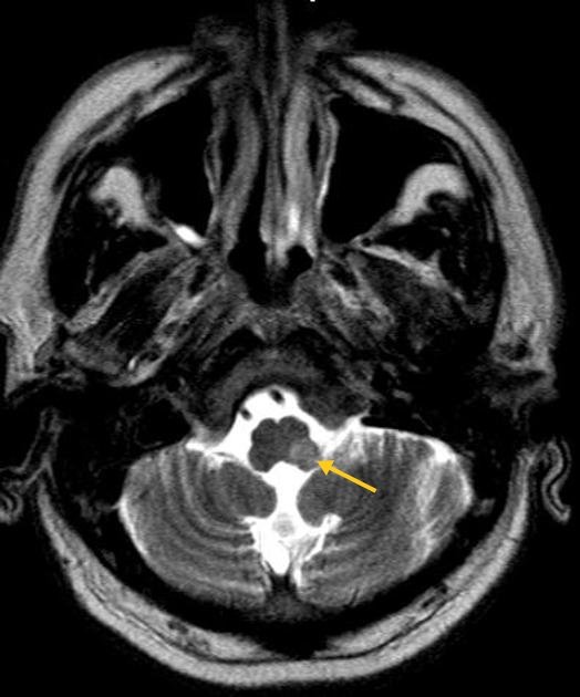 74yo hypertensive (not on medications),sudden onset headache&dizziness while driving. He developed unsteady gait,dysphagia, hoarseness &diplopia within 2 hrs;BP-170/100. Loss of pain & temperature on the left side of face & right half of body. Diagnosis?
#MedTwitter #neurotwitter