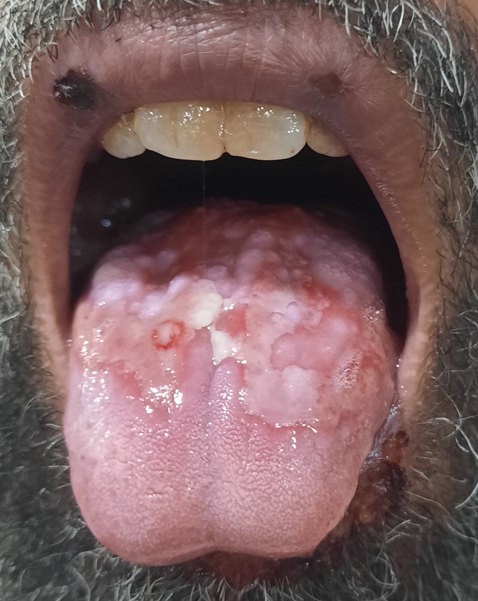 45 years old pt came with severe pain and burning on tongue for 4 days. He is taking Nistat drops but condition not improving. No Co Morbid. Hx is insignificant for any other system illness.
Dx..? And Rx..? 
#withpermission.