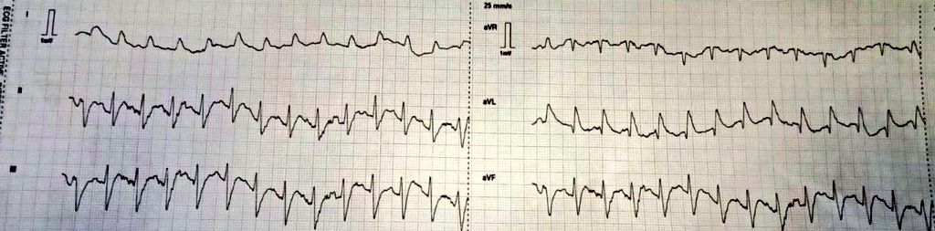 CP & VF. Thoughts?

@DidlakeDW @ecgrhythms @EM_RESUS @Jagdish26039718 @RobertHermanMD @smithECGBlog @AslangerE 

#CardioTwitter #MedTwitter #cardiovascular #Cardiology #cardioED #ECG #EKG