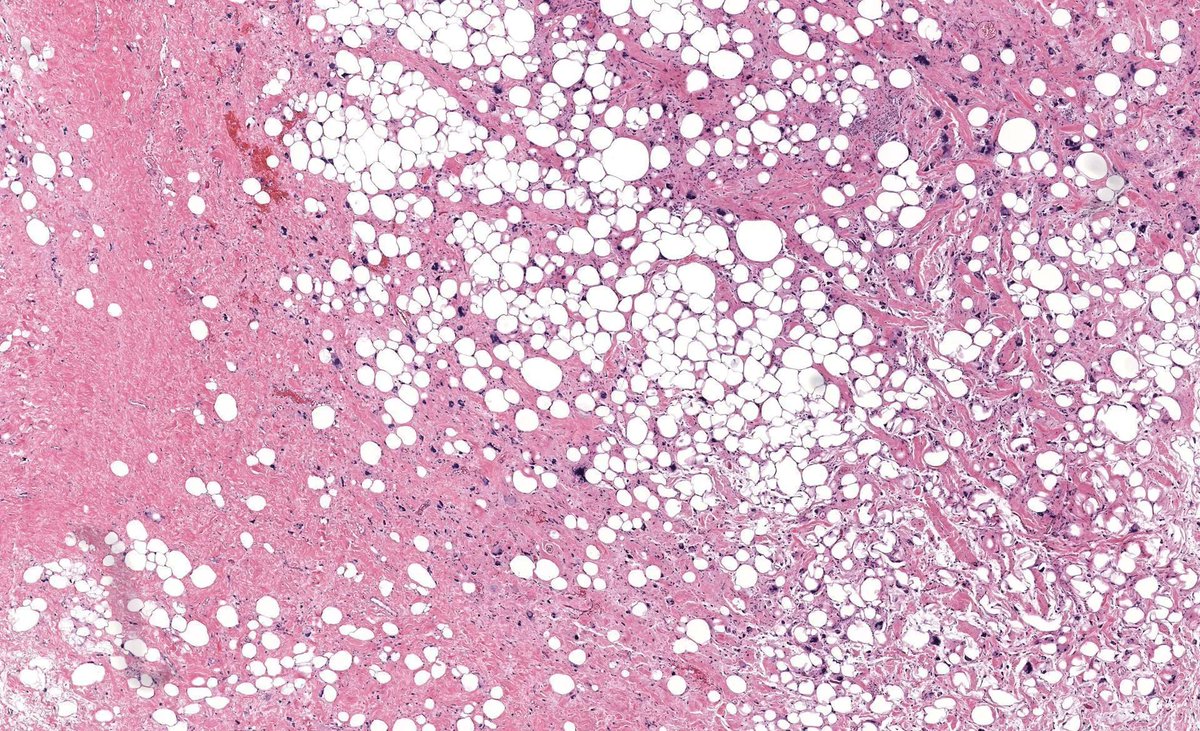 JMGardnerMD's tweet image. 12cm subcutis mass. Back of middle aged woman. MDM2 negative. Your diagnosis? 
Digital slides: kikoxp.com/posts/5829
Answer &amp;amp; video: kikoxp.com/posts/8520
Handout &amp;amp; #pathology report template: kikoxp.com/posts/8521
#pathTwitter #dermpath #dermatology #dermtwitter #BSTpath