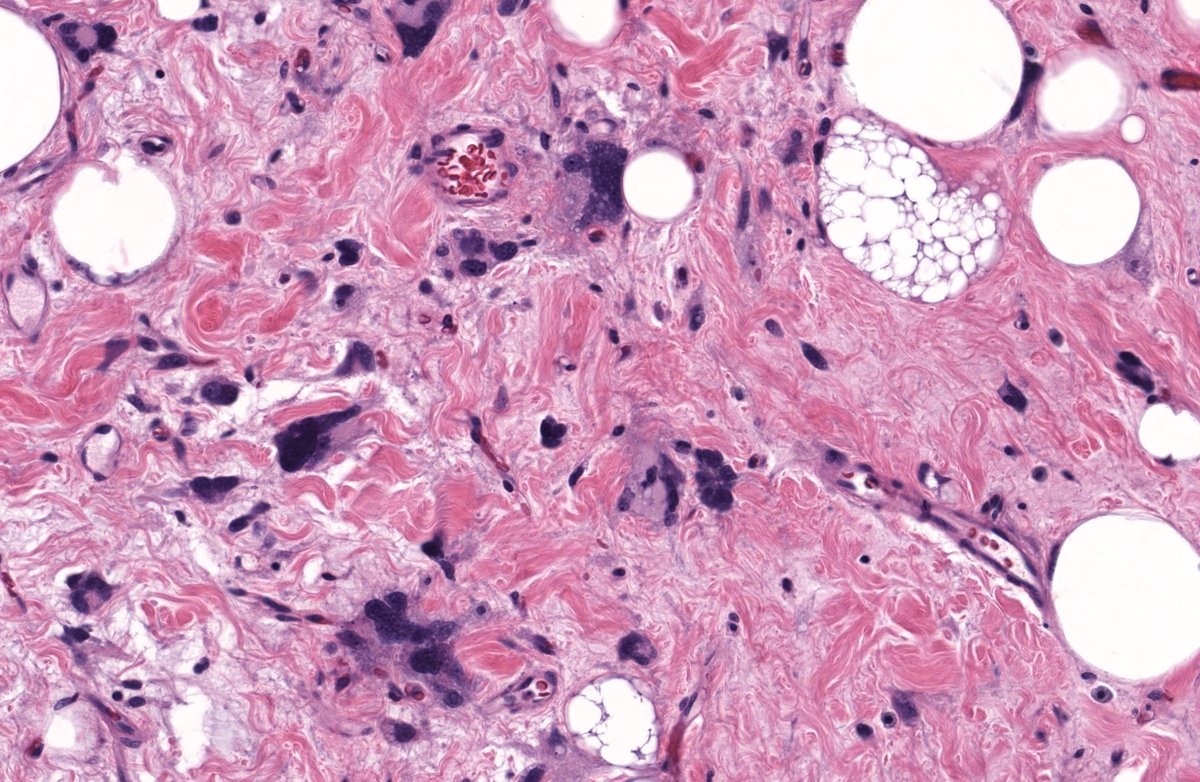 JMGardnerMD's tweet image. 12cm subcutis mass. Back of middle aged woman. MDM2 negative. Your diagnosis? 
Digital slides: kikoxp.com/posts/5829
Answer &amp;amp; video: kikoxp.com/posts/8520
Handout &amp;amp; #pathology report template: kikoxp.com/posts/8521
#pathTwitter #dermpath #dermatology #dermtwitter #BSTpath