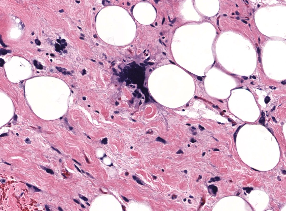 JMGardnerMD's tweet image. 12cm subcutis mass. Back of middle aged woman. MDM2 negative. Your diagnosis? 
Digital slides: kikoxp.com/posts/5829
Answer &amp;amp; video: kikoxp.com/posts/8520
Handout &amp;amp; #pathology report template: kikoxp.com/posts/8521
#pathTwitter #dermpath #dermatology #dermtwitter #BSTpath