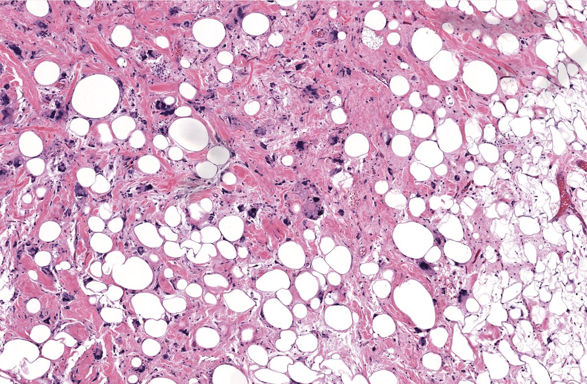 JMGardnerMD's tweet image. 12cm subcutis mass. Back of middle aged woman. MDM2 negative. Your diagnosis? 
Digital slides: kikoxp.com/posts/5829
Answer &amp;amp; video: kikoxp.com/posts/8520
Handout &amp;amp; #pathology report template: kikoxp.com/posts/8521
#pathTwitter #dermpath #dermatology #dermtwitter #BSTpath