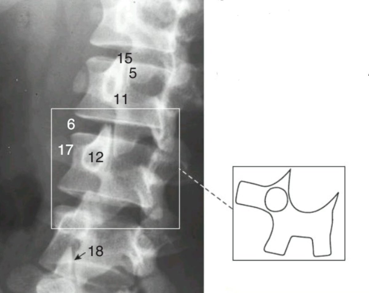 En una proyección oblicua de la #ColumnaLumbar, se puede observar el perrito de #LaChapelle. El hocico (17) en la #ApófisisTransversa; la oreja (15) es la #ApófisisArticular superior; el ojo (12) es el #pedículo.
📚 Atlas Clínico de Anatomía Humana. Ed. Médica Panamericana
