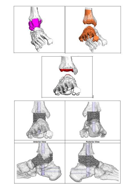 YorkshireFoot's tweet photo. Proud to have performed our first 3D printed custom-made hindfoot cage fusion @RotherhamNHS_FT 

#surgery #orthotwitter #yorkshire #Doncaster https://t.co/qdrWbFKbwu