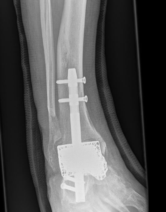 YorkshireFoot's tweet photo. Proud to have performed our first 3D printed custom-made hindfoot cage fusion @RotherhamNHS_FT 

#surgery #orthotwitter #yorkshire #Doncaster https://t.co/qdrWbFKbwu