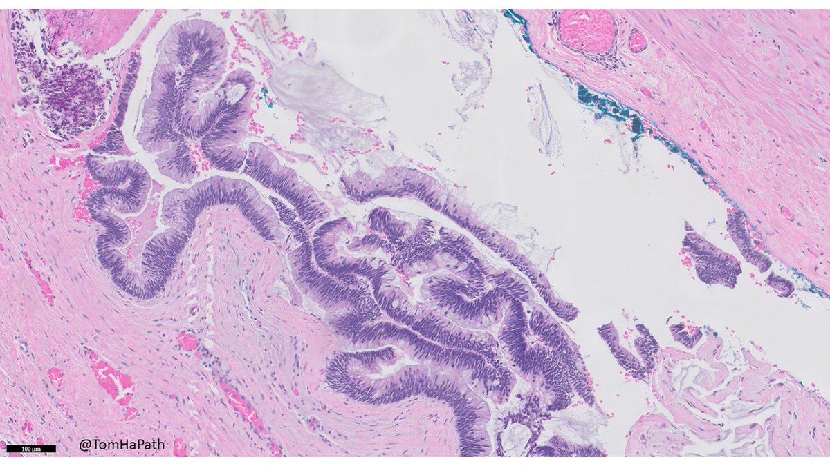 TomHaPath's tweet image. Found in an appendix, imaging showed "mucocele"
#PathTwitter #Pathology #GIPath
