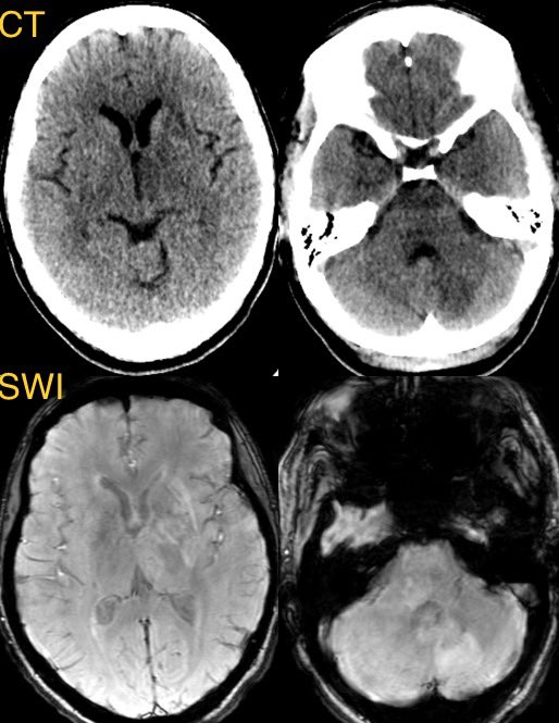 CNS involvement of systemic lupus erythematosus w/ anti-phospholipid syndrome in this 40 y/o F w/ weakness and cognitive impairment

Imaging in 🧵
#Neurology #neurosurgery @TheASNR #MedEd #MedTwitter #neurotwitter