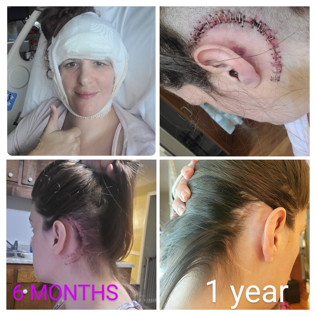 Martinigirl881's tweet photo. Today's the 1 year #anniversary of my #brainsurgery.  Finally I'm really present for all life's precious moments. #Struggling through excruciating #TrigeminalNeuralgia #pain. It's been a long #recovery but what a difference #ayear can make never take life for granted. #OneYearAgo https://t.co/72vfYys4OL