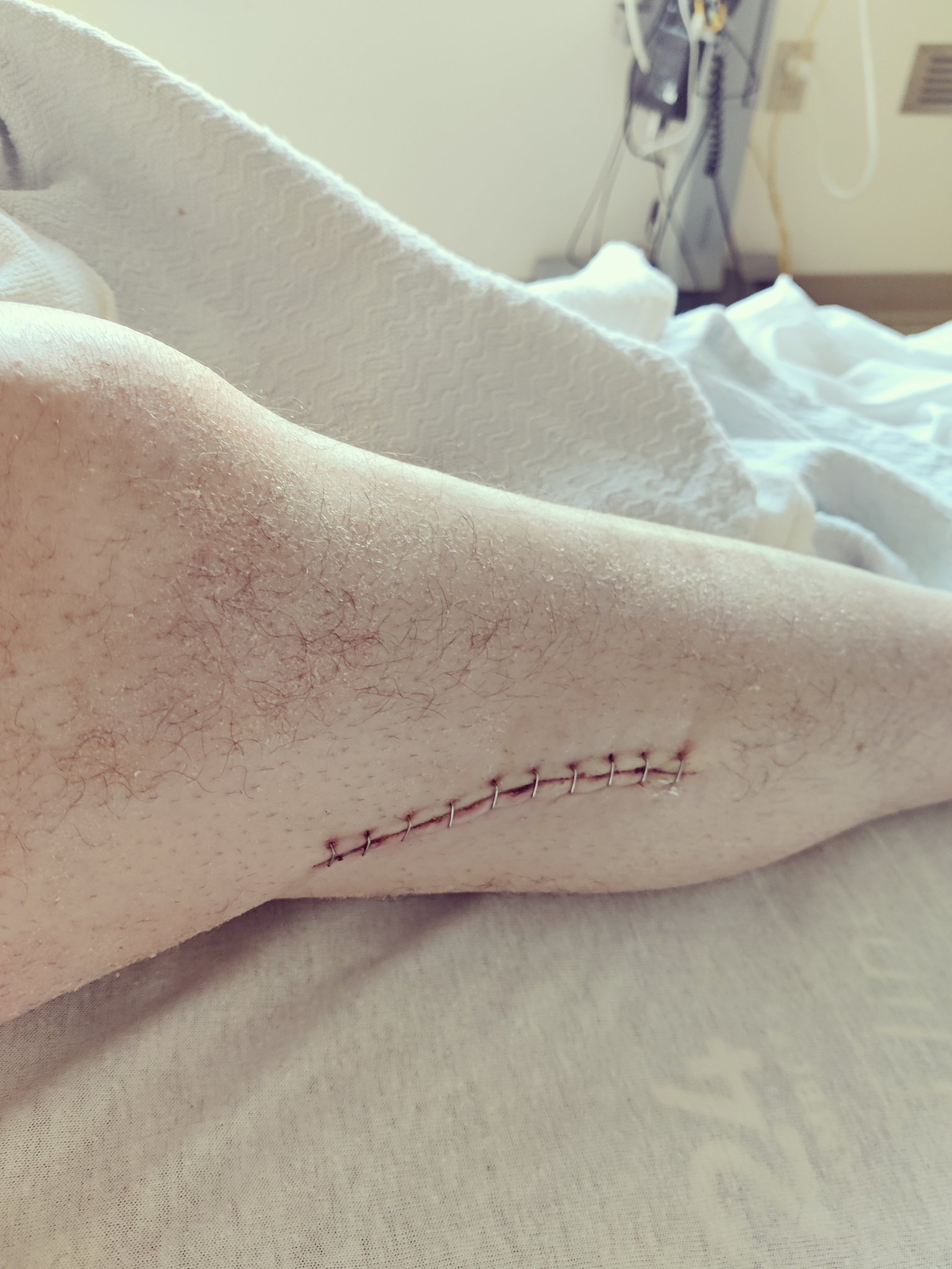 2 pic. @PatMcAfeeShow Just in case no one believes me about my last post about blood clots. Here's my proof. @DeionSanders get well soon brother, it's going to take a step at a time, but just be prime!! It's a long road, and I'll battle with you. https://t.co/tagYLKHL9b