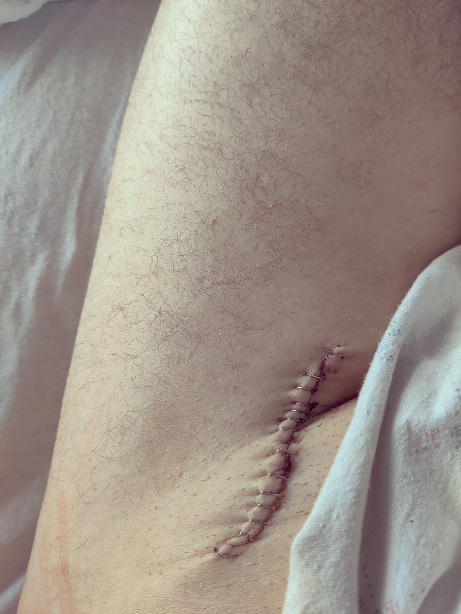 3 pic. @PatMcAfeeShow Just in case no one believes me about my last post about blood clots. Here's my proof. @DeionSanders get well soon brother, it's going to take a step at a time, but just be prime!! It's a long road, and I'll battle with you. https://t.co/tagYLKHL9b