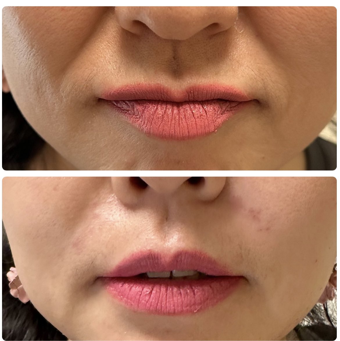 This client was ready to fill in her nasolabial folds. Just a little went a long way for her. Call me @monamispa to get a consult!! #пр #medspa #juvederm #filler #skin #spa #aesthetic #allergan #injector