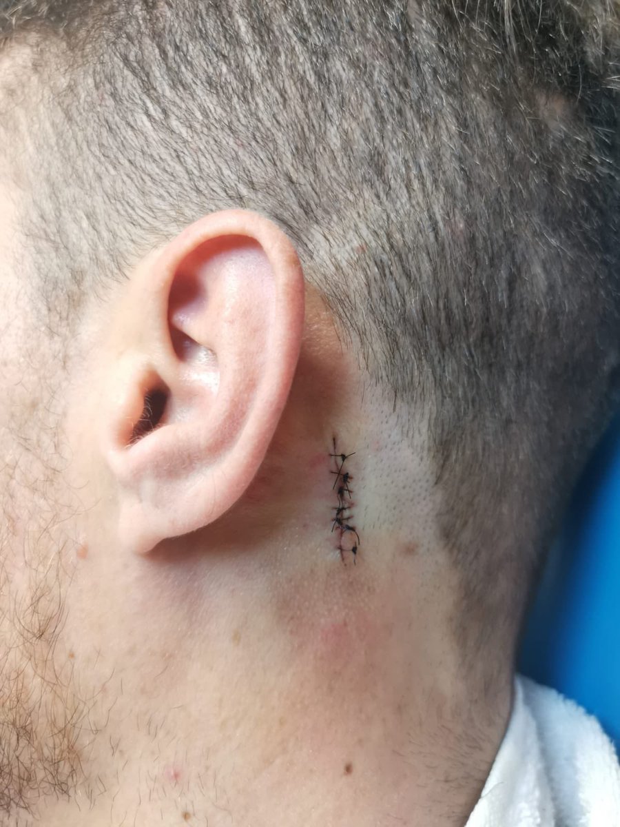 Spotted from 6 feet away a characteristic ABCDE skin lesion on my friend’s neck. Recommended prompt medical attention, the very next day a dermatologist removed it #melanoma  🔜  Moh’s surgery
