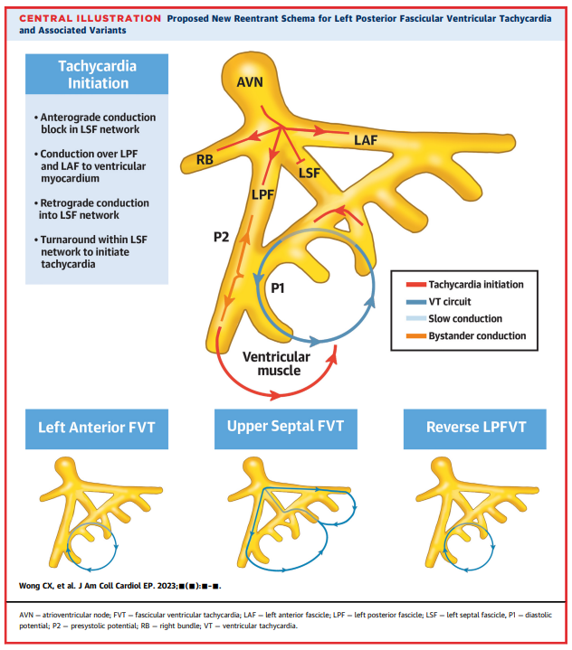 WongChrisX's tweet image. Fascicular Ventricular Tachycardias: Potential Role of the Septal Fascicle

Honored to propose this new schema with @MelScheinman @AkihikoNogami @HHsiaMD @satoshihgc

Free access via @JACCJournals link below🔽for 1 month

rb.gy/gd3ev

#EPeeps #VTach #Fascicular