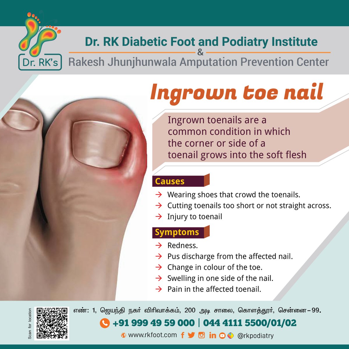 #DrRKsUpdate | Ingrown toe nail 

உங்கள் கால் குணமாக நாங்கள் கைகொடுக்கிறோம்! 

உங்கள் ‘பாத’ பிரச்சனைகளுக்கு நாங்கள் தீர்வளிக்கின்றோம்.. 

எங்களுடன் பேச: +91 999 49 59 000 

#DrRKDiabeticFootandPodiatryInstitute | #FootPain | #DiabeticFootCare