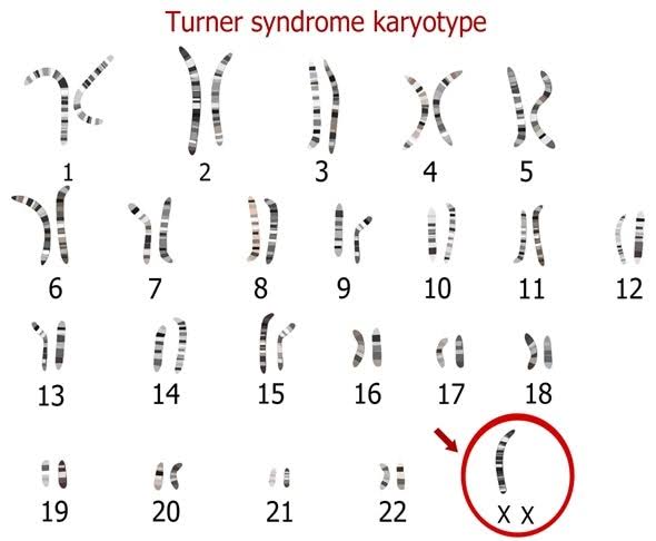4/n
🤰Diagnosis:
-antenatal USG: short femur,cardiac anomalies
-karyotyping (45 XO- monosomy X)
-Amniocentesis
-low Anti-Mullerian hormone

💉Rx of Turner's:
-Growth Hormone
-low dose Androgens
-Estrogen therapy
-IVF