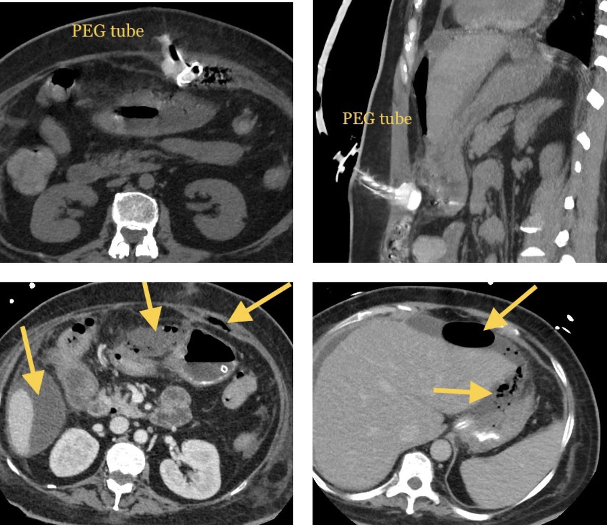 50/F, Post PEG tube insertion day1, post 2 feeds-fever, abdo pain + tenderness.
What’s happening? Mx?
.
#irad #radres #foamrad #MedTwitter #MedEd @doctorboletoh @nihardesai7 @keithppereira @DharJahnvi @docdhir @Guiro_IRad @drochohan @LessneVIR @SRajesh_IR @vascularIR @iRadRock