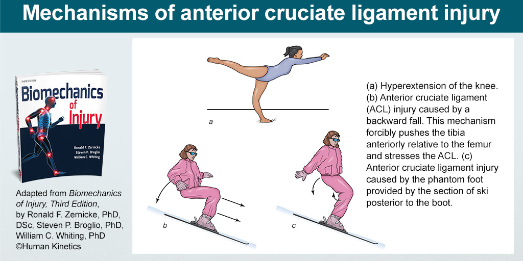 ACL injury happens most often in response to valgus loading in combination with external tibial rotation or to hyperextension with internal tibial rotation. Learn more with Biomechanics of Injury 3e. #biomechanics #sportsinjuries  bit.ly/44006fR