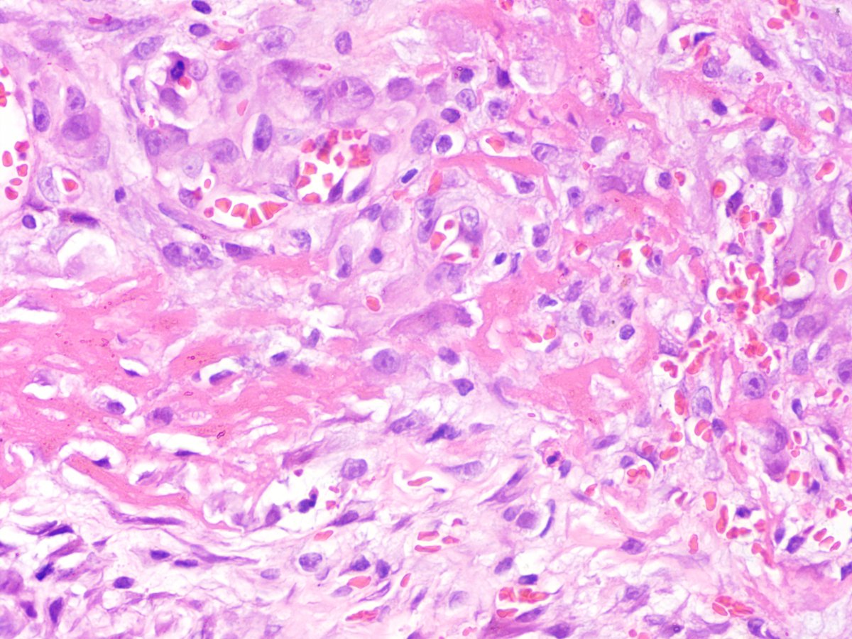 young male well defined swelling 4x4 forearm, adherant to radial nerve #pathology #PathologyWeek #pathologists #PathTwitter